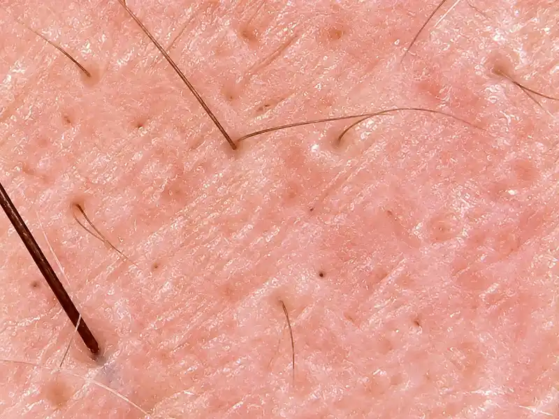 Falência folicular identificado pelo exame capilar